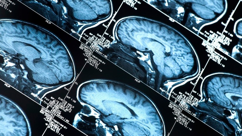 Brain scan image
