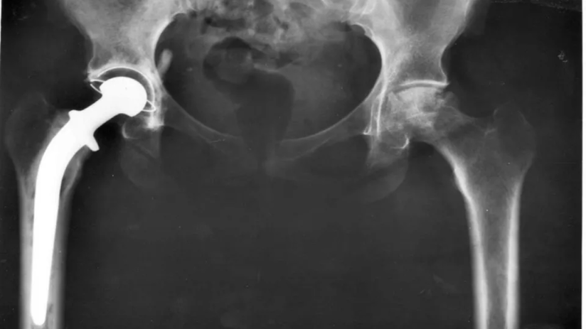 Smith & Newphew is one of the world’s largest hip replacement manufacturers.